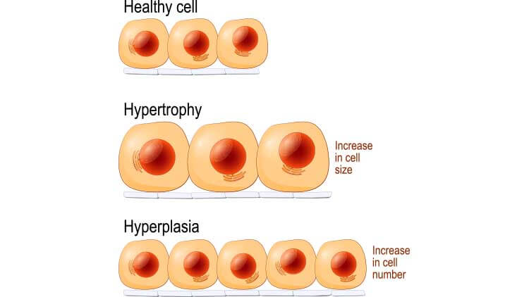 Cellules normales, hypertrophie et hyperplasie